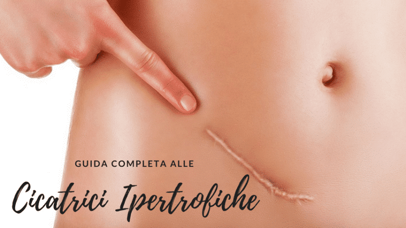 Cicatrice Ipertrofica | Cosa è e come migliorare l’aspetto