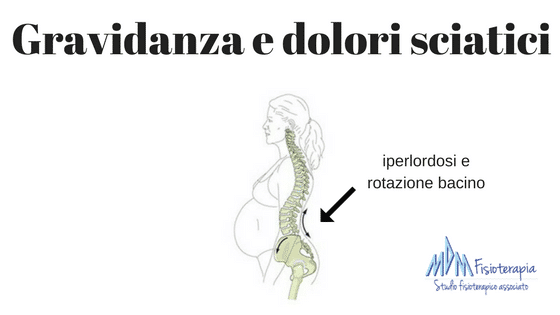 Gravidanza e dolori sciatici