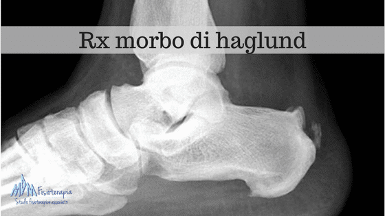 Rx morbo di haglund