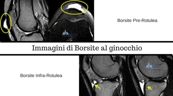 Immagini di Borsite al ginocchio
