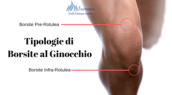 Tipologie di borsite al ginocchio