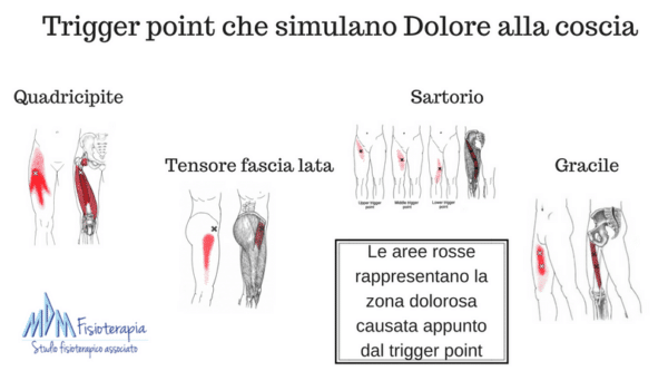 Trigger point che simulano Dolore alla coscia