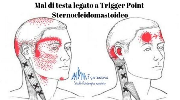 Mal di testa Trigger Point Sternocleidomastoideo