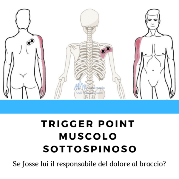 trigger point sottospinoso cervicobrachialgia