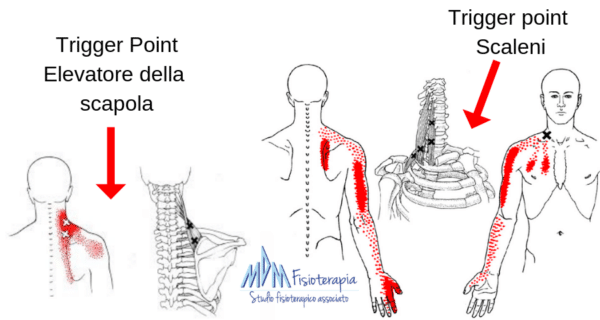 Trigger Point Elevatore della scapola e scaleni