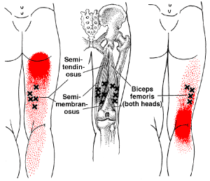 trigger point bicipite femorale