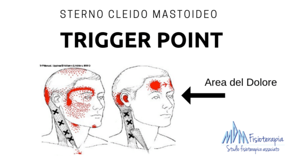 Trigger point sternocleidomastoideo