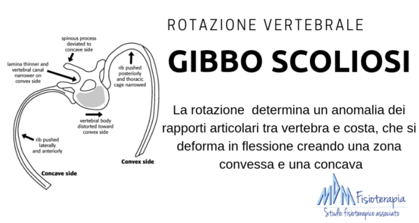 gibbo scoliosi