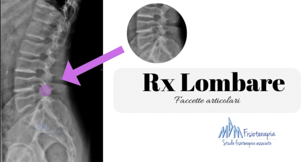 Rx colonna lombare sindrome faccette articolari