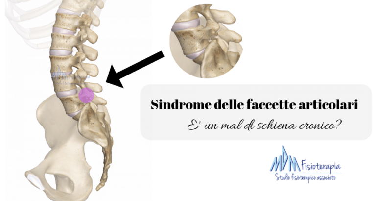 Sindrome delle faccette articolari | Quel mal di schiena che non passa