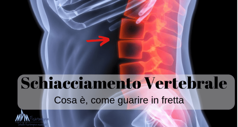 Schiacciamento vertebre