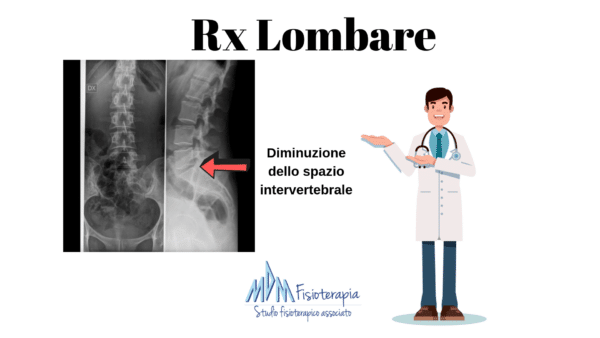 rx lombare per schiacciamento vertebre