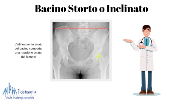 bacino storto