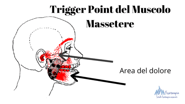 Trigger point del massetere