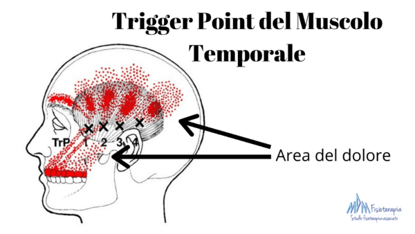 Trigger point del temporale