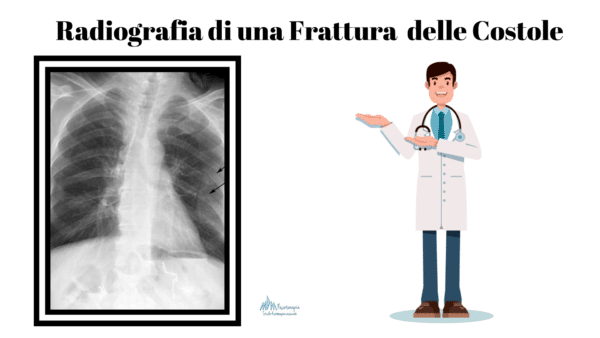 Radiografia frattura costole