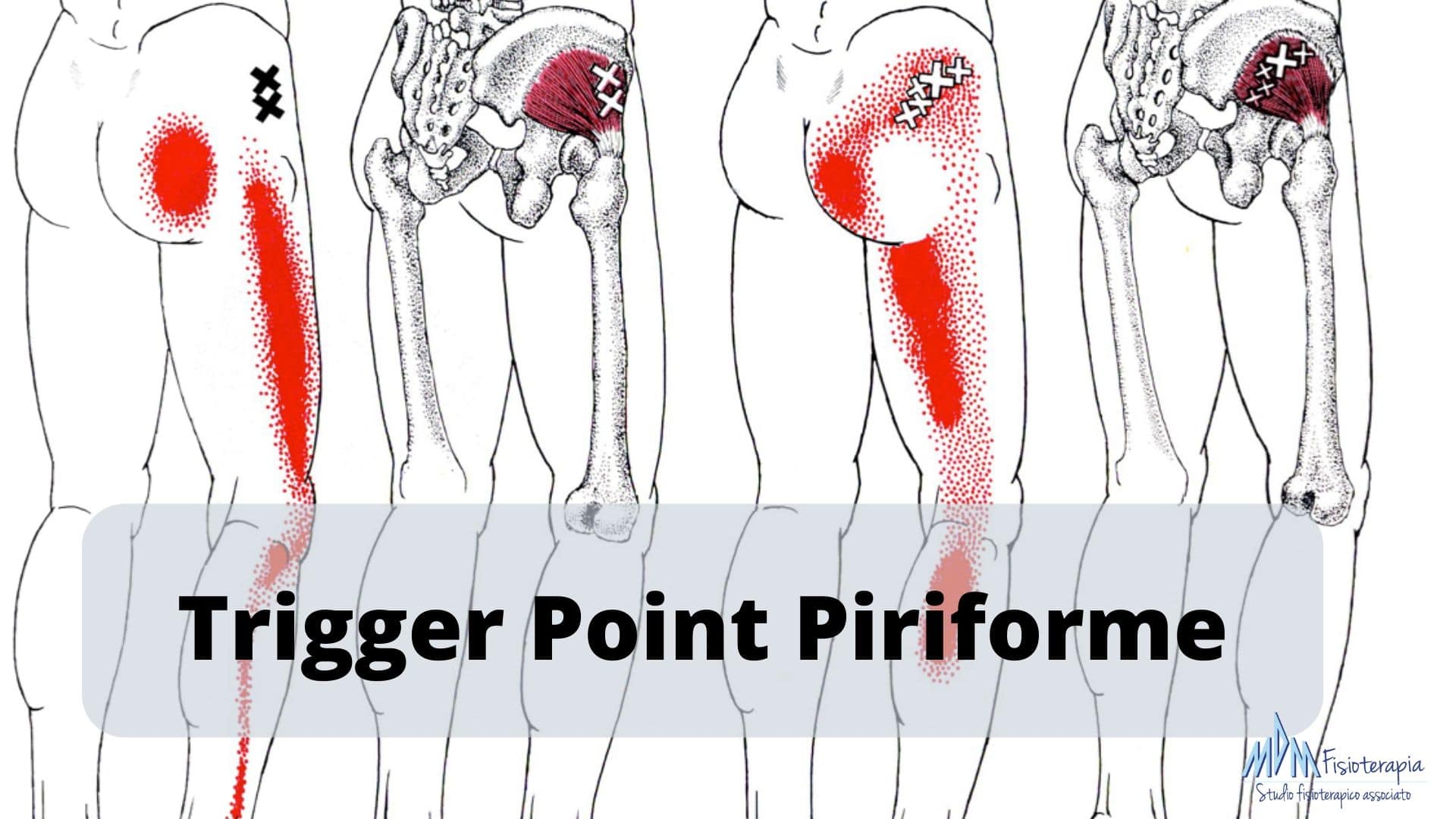 Trigger Point Piriforme Scopri come agire! Mdm Fisioterapia
