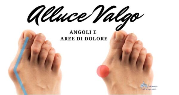 alluce valgo cosa è