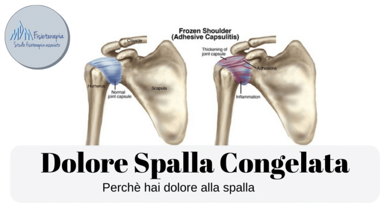 Dolore spalla Congelata e capsulite adesiva