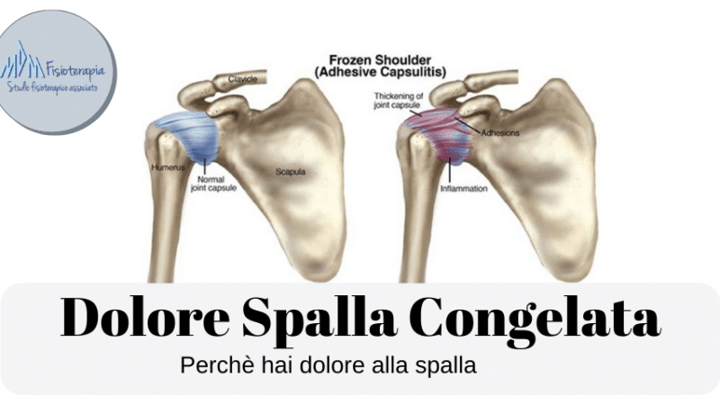 Dolore spalla Congelata e capsulite adesiva