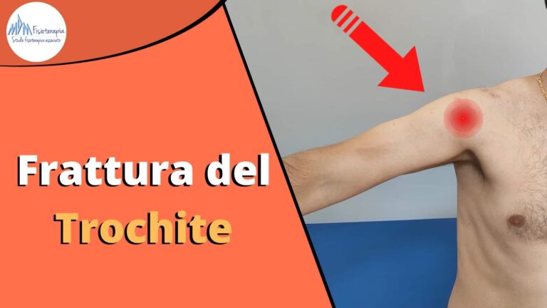 Frattura Trochite | Cosa è, Fisioterapia e Riabilitazione