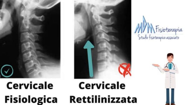 cervicale normale e rettilinizzazione cervicale